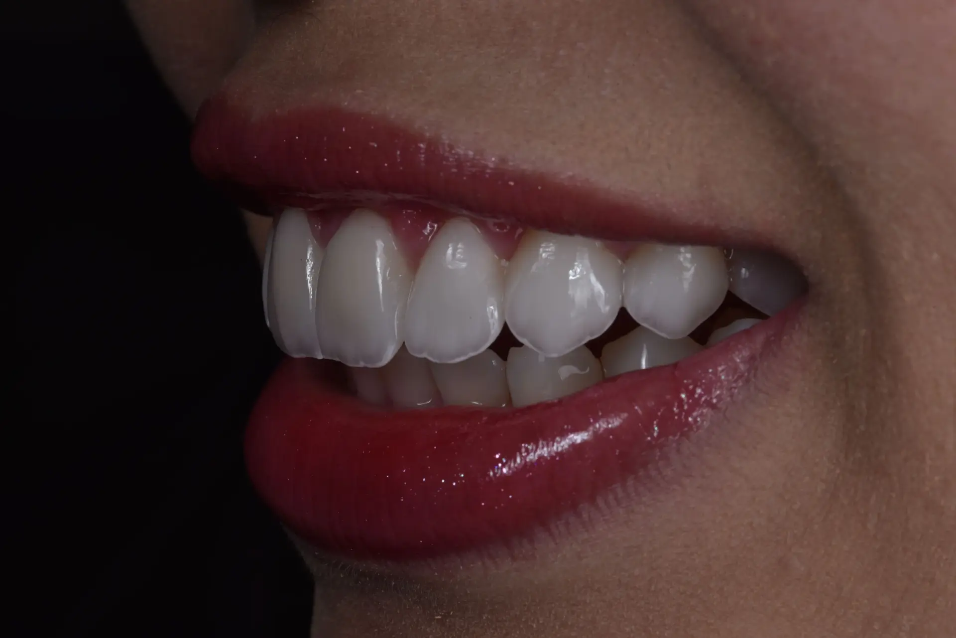 Sorriso com prótese dentária